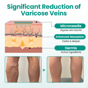 LAOZIK® LegRenew Varicose Veins Patch
