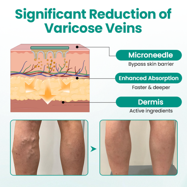 LAOZIK® LegRenew Varicose Veins Patch